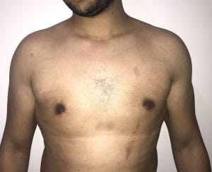 Stage 3 gynecomastia treated by Male Breast Reduction by Dr Wilson at the Best Cosmetic Surgery in Egypt
