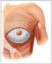 Dual Plane for Breast Enlargement Augmentation at Best Plastic Surgery in Egypt