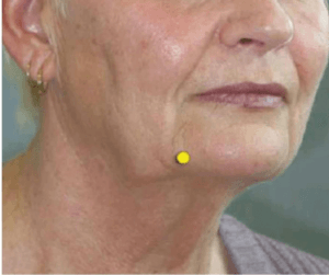 Buccal Pad of Fat causing Jowls removed at Best Aesthetic Surgery Egypt