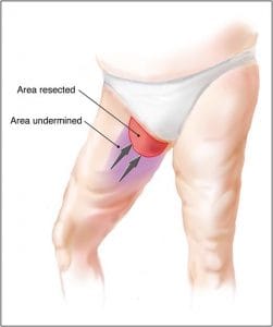 Thigh Lift and Thigh Liposuction at Best Aesthetic Surgery in Egypt