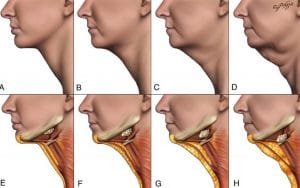 Neck Lift Degrees Neck Lift and Neck Liposuction at Best Plastic Surgery in Egypt at Nile Cosmetic Center