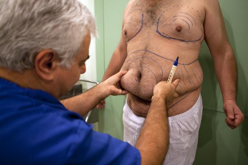 Tummy Liposuction Cosmetic Surgery Tummy Vaser High Definition Liposuction at Best Plastic Surgery