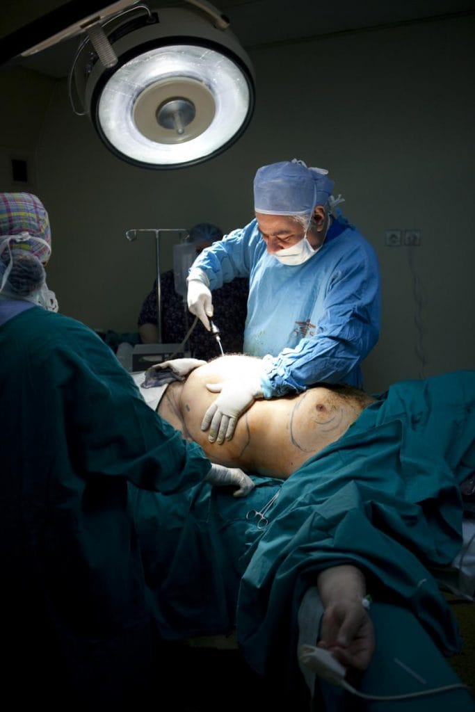 Vaser Smart Liposuction Tummy Vaser High Definition Liposuction at Best Aesthetic Surgery