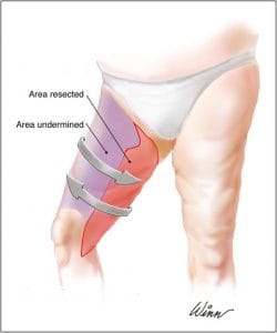 Vertical Thigh Lift and Thigh Vaser Liposuction at Best Plastic Surgery egypt