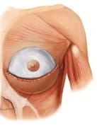 Inverted Dual Plane for Breast Enlargement Augmentation at Best Plastic Surgery in Egypt