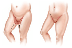 Thigh Lift and Thigh Liposuction at Best Cosmetic Surgery in Egypt