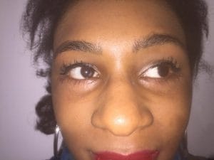 Cateye Blepharoplasty Eyelid Surgery and Cateye Blepharoplasty at Best Plastic Surgery in Egypt