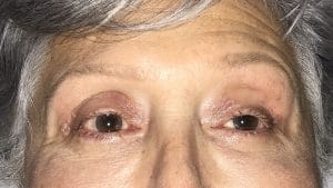 Eyelid Fat Injection (1) Hollow Eyelids treated by Fat Injection and Upper Eyelid Surgery at Best Cosmetic Surgery Egypt