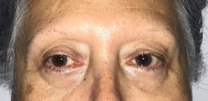 Eyelid Fat Injection (2) Hollow Eyelids treated by Fat Injection and Upper Eyelid Surgery at Best Plastic Surgery Egypt