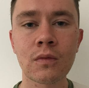 Chubby cheeks treated by Buccal Fat Removal and Vaser Liposuction at Best Aesthetic Surgery Egypt