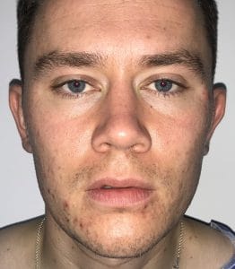 Chubby cheeks treated by Buccal Fat Removal and Vaser Liposuction at Best Plastic Surgery Egypt