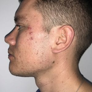 Chubby cheeks treated by Buccal Fat Removal and Vaser Liposuction at Best Cosmetic Surgery Egypt