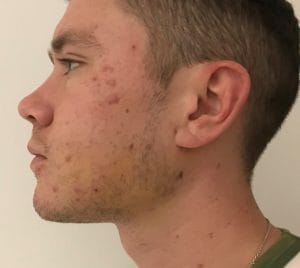 Fat cheeks treated by Buccal Fat Removal and Vaser Liposuction at Best Plastic Surgery Egypt