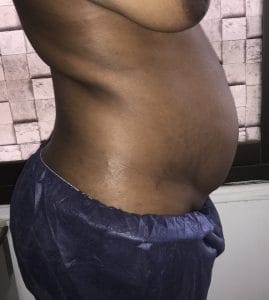 Overhanging belly treated by Waist, Flank, Tummy High Definition Liposuction using Vaser at Best Plastic Surgery in Egypt