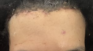 Forehead Narrowing and Hairline Advancement at Best Plastic Surgery Egypt with Scar Surgery