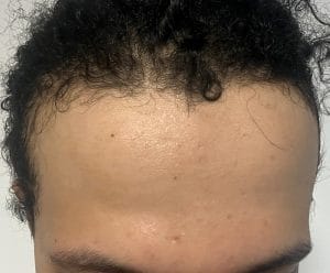 Forehead Narrowing and Hairline Advancement at Best Plastic Surgery Egypt with Botox Injection