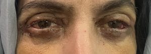 Eyelid Wrinkles Blepharoplasty (1) Cosmetic Upper and Lower eyelid Blepharoplasty to remove wrinkles at Best Cosmetic Surgery Egypt