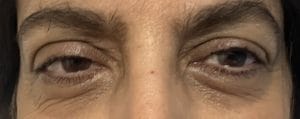 Eyelid Wrinkles Blepharoplasty (2) Cosmetic Upper and Lower eyelid Blepharoplasty to remove wrinkles at Best Plastic Surgery Egypt
