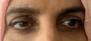 Blepharoplasty Cosmetic Best Plastic Surgery Egypt for Blepharoplasty and Eyelid Surgery and Eyebags