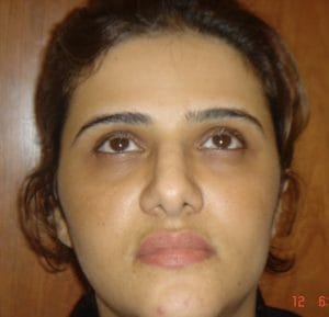 Buccal fat removal for Chubby face and Face Definition and Jawline at Best Plastic surgery Egypt