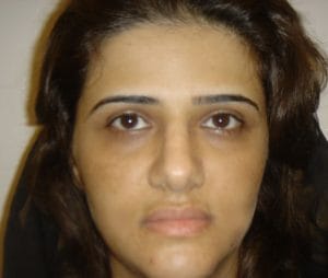 Buccal fat removal for Chubby face and Face Definition and Jawline at Best Cosmetic Surgery Egypt