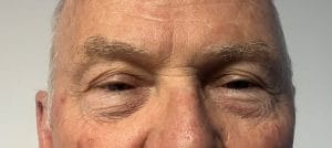 Upper and Lower Eyelid Blepharoplasty (2) Upper and Lower Eyelid Blepharoplasty to treat Bags and Puffy Eyelids at Best Plastic Surgery Egypt