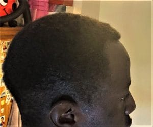 Receding hairline and Forehead narrowing treated by hairline advancement at Best Cosmetic Surgery in Egypt