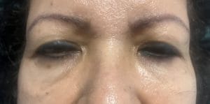 Upper and Lower Eyelid Blepharoplasty (1) Tatoo eyelid with lax eyelid and Baggy eyelids treated by Upper and Lower Blepharoplasty at Best Plastic Surgery in Egypt
