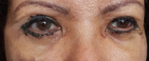 Upper and Lower Eyelid Blepharoplasty (2) Tatoo eyelid with lax eyelid and Baggy eyelids treated by Upper and Lower Blepharoplasty at Best Cosmetic Surgery in Egypt