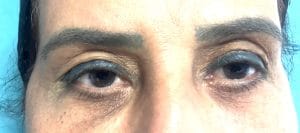 Blepharoplasty Eyelid lift (2) Redo upper and lower eyelid lift after previous blepharoplasty at Best Plastic Surgery in Egypt