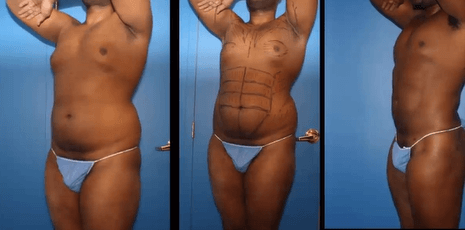 Smart High Definition Liposuction for Abs and 6 packs and Male chest Liposuction at Best Plastic Surgery Egypt