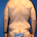 Best Plastic Surgery Egypt for 360 degree Tummy and Back and Waist High Definition Vaser Liposuction and Back Lift and Waist Lift