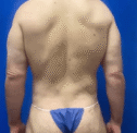 Best Cosmetic Surgery Egypt for 360 degree Tummy and Back and Waist High Definition Vaser Liposuction and Back Lift and Waist Lift