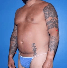 High Definition Vaser Smart Liposuction for the Tummy and waist to create six packs at Best Plastic Surgery in Egypt