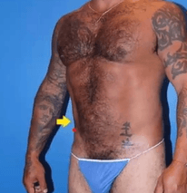 High Definition Vaser Smart Liposuction for the Tummy and waist to create six packs at Best Cosmetic Surgery in Egypt