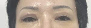 Upper Eyelid fold Blepharoplasty (1) Overhanging skin and Double folds in Upper Eyelid treated by Upper Eyelid Blepharoplasty at Best Cosmetic Surgery Egypt