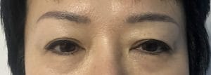 Upper Eyelid fold Blepharoplasty (2) Overhanging skin and Double folds in Upper Eyelid treated by Upper Eyelid Blepharoplasty at Best Plastic Surgery Egypt