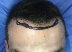Large forehead and Receding Hairline and Hairline Advancement with Forehead narrowing at Best Aesthetic Surgery in Egypt