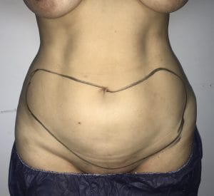 Tummy High Definition Smart vaser Liposuction to Delineate abs at best Plastic Surgery