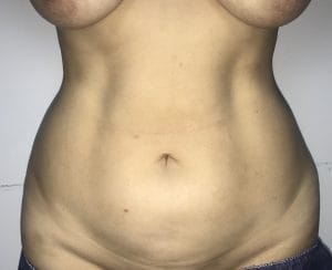 Tummy High Definition Smart vaser Liposuction to Delineate abs at best Cosmetic Surgery