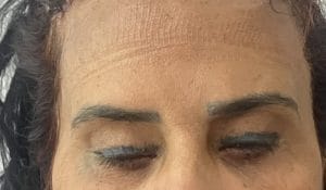 Brow Lift Cosmetic Surgery (2) Brow Lift after Eyelid surgery to raise Eyebrows at Best Plastic Surgery