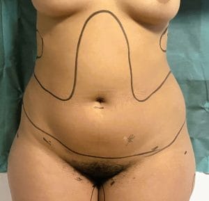 Fat grafting and Tummy HD Liposuction High Definition Liposculpture Tummy and Waist Definition and Ab delineation at Best Plastic Surgery Egypt