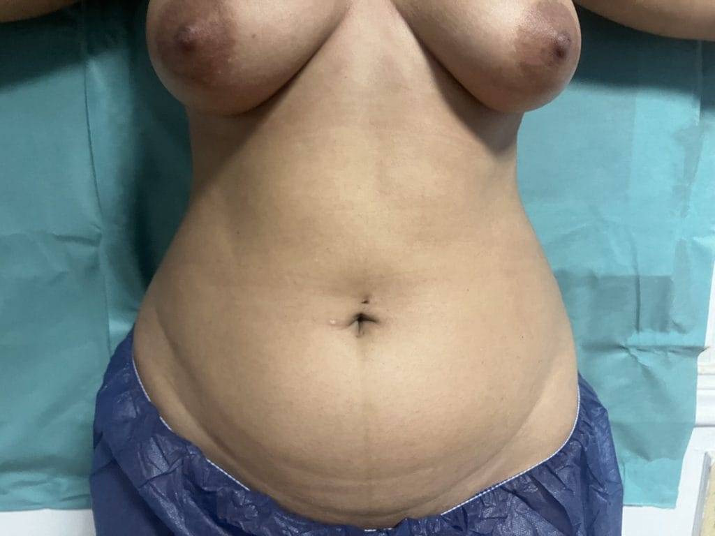 Best Plastic Surgery in Egypt for Tummy and waist and Flank High definition Smart Vaser Liposuction