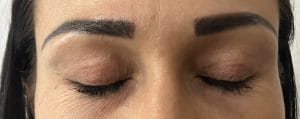 Upper Eyelid Lift Blepharoplasty Skin hood (1) Upper eyelid lax skin and hooding treated by Upper Eyelid Blepharoplasty at Best Aesthetic Surgery
