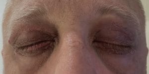 Upper Eyelid and Lower Eyelid Lift (1) Upper and Lower eyelid Surgery Blepharoplasty for Eyelid Bags at Best Cosmetic surgery Egypt