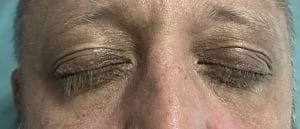 Upper Eyelid and Lower Eyelid Lift (2) Upper and Lower eyelid Surgery Blepharoplasty for Eyelid Bags at Best Plastic surgery Egypt