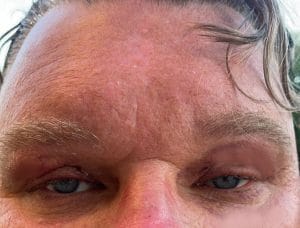 Upper Eyelid surgery and Forehead Lift (1) Droopy Upper eyelids and Overhanging Eyebrow for Upper Eyelid Blepharoplasty and Forehead Eyebrow Lift at Best Cosmetic surgery