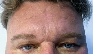 Upper Eyelid surgery and Forehead Lift (2) Droopy Upper eyelids and Overhanging Eyebrow for Upper Eyelid Blepharoplasty and Forehead Eyebrow Lift at Best Plastic surgery