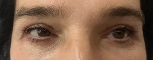 Eyelid Lift Blepharoplasty Eye bags (2) Fat Bags and excess skin for Upper Eyelid Lift Blepharoplasty and Lower Eyelid Lift Blepharoplasty at Best Cosmetic Surgery egypt