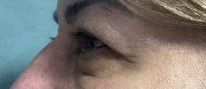 Eyelid lift for Eyelid bags (1) Eyelid wrinkles and Fat Bags and Drooping Upper Eyelid treated by Eyelid Lift blepharoplasty at Best Plastic Surgery Egypt